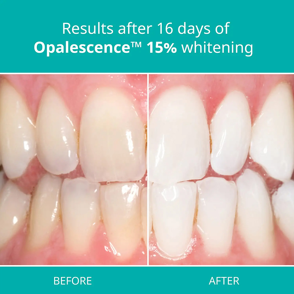 Żel do wybielania zębów zestaw – Teeth Whitening Gel Opalescence recenzja i cena