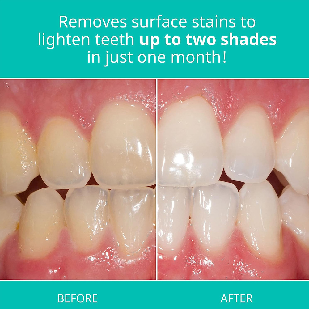 Wybielająca opalescencja pasta – Teeth Whitening Gel Opalescence recenzja i cena