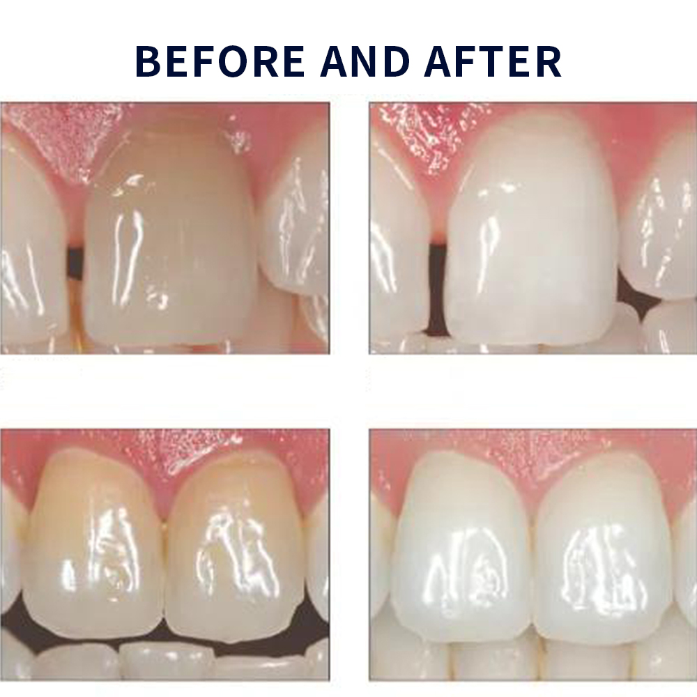 Opalescence Whitening 20% PF 2 – Teeth Whitening With Peroxide recenzja i cena