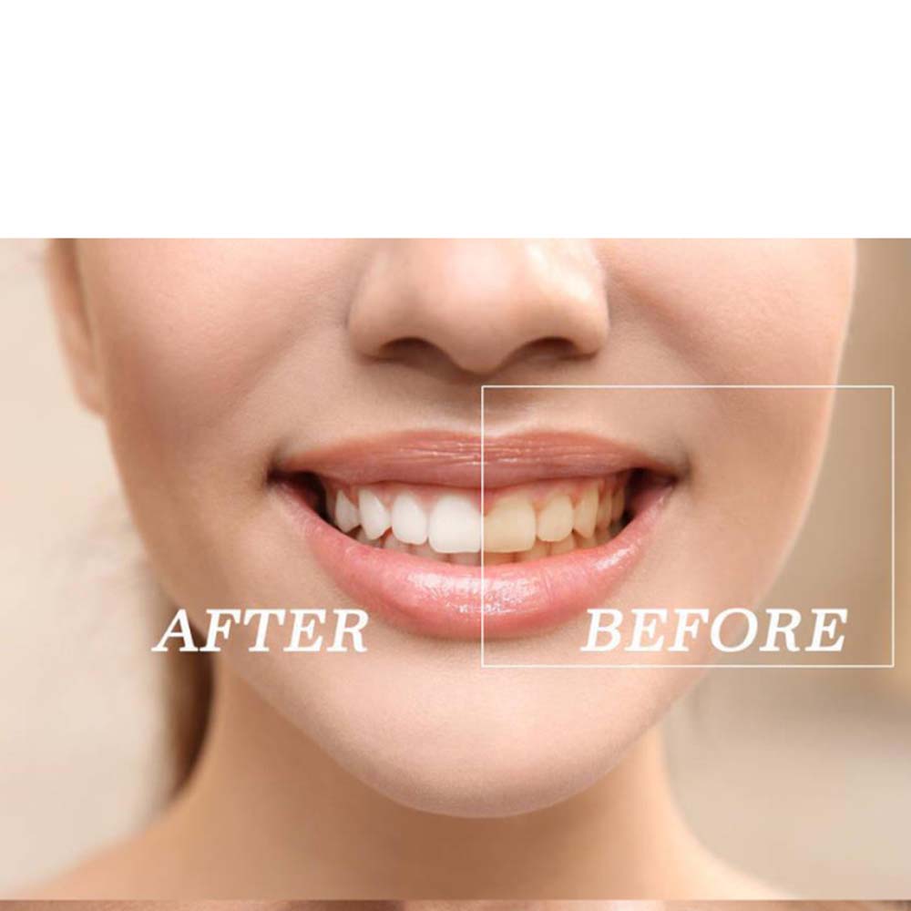 Najwyższej jakości zestaw żelo – Teeth Whitening Led Kit recenzja i cena
