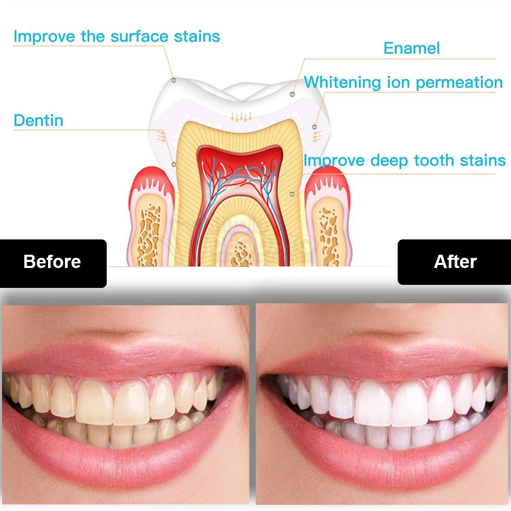 Zestaw do wybielania zębów den – Teeth Whitening With Peroxide recenzja i cena