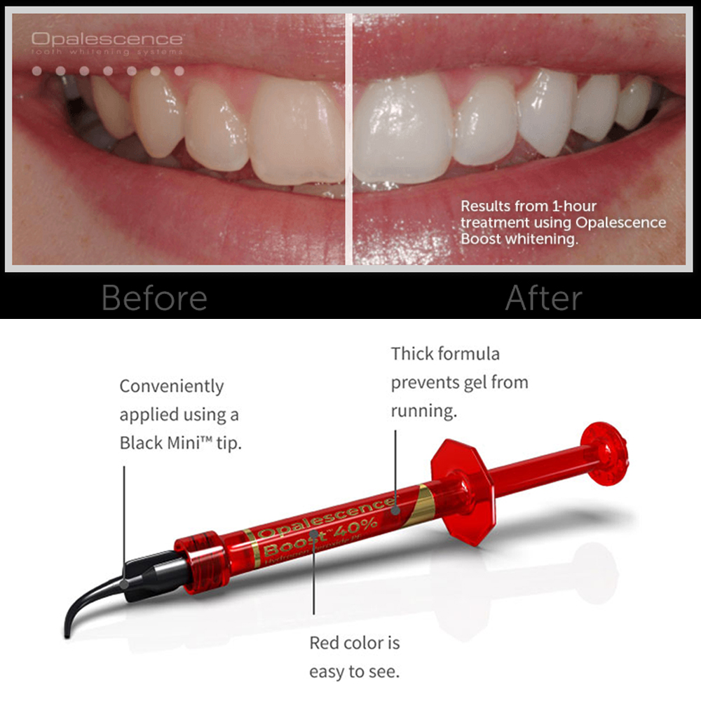 Ultradent Opalescence Boost PF – Teeth Whitening Gel Opalescence recenzja i cena